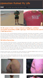 Mobile Screenshot of liposuctionruinedmylife.com